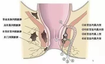 肛瘘多是由肛周脓肿溃破或手术后遗造成的.