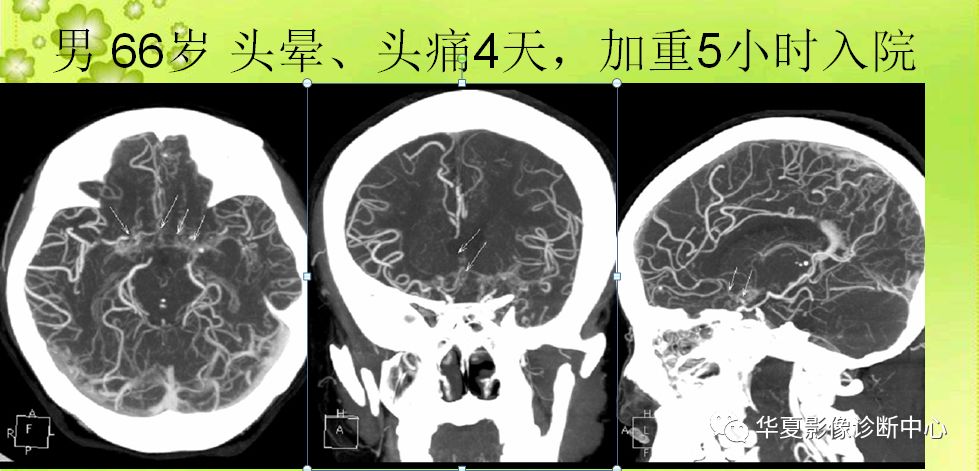 头部血管性疾病的cta诊断