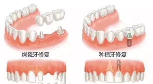 人口种植牙好吗_半口种植牙成活率高吗(2)