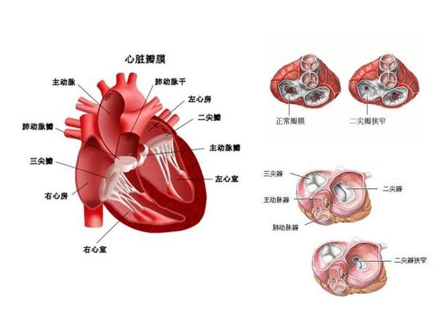 二尖瓣狭窄患者保养五大准则