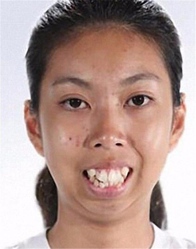 ▼▼▼ 另外一个是关于泰国女孩的故事 19岁的女孩天生有龅牙 朋友们