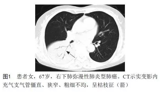 一文教你如何通过看星星,看美女,看武侠学习肺部ct!