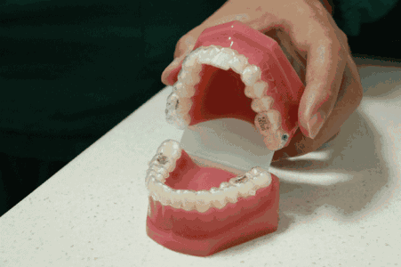 牙齿矫正疼得要命?到底有多痛?