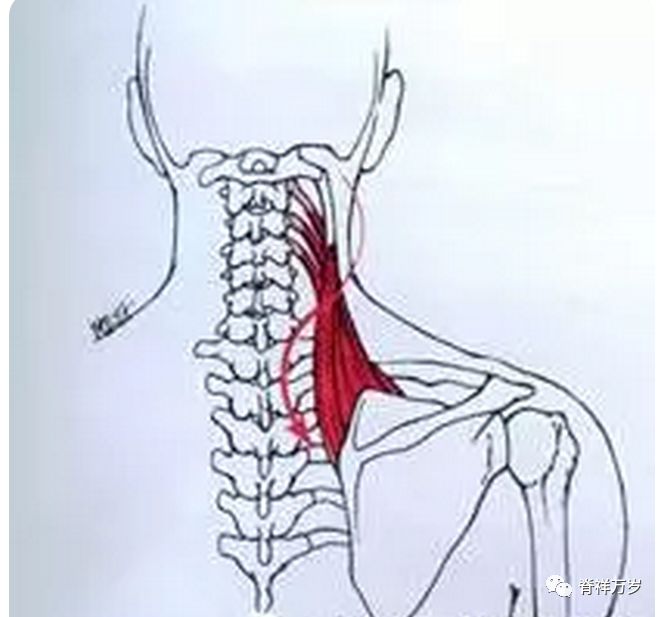 止点 肩胛骨上角起点 第1~4颈椎横突起止点:肩胛提肌上斜方肌无力还会
