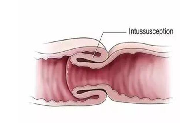 6个月的宝宝肚子痛,婆婆说没大问题,送医院医生说是肠套叠