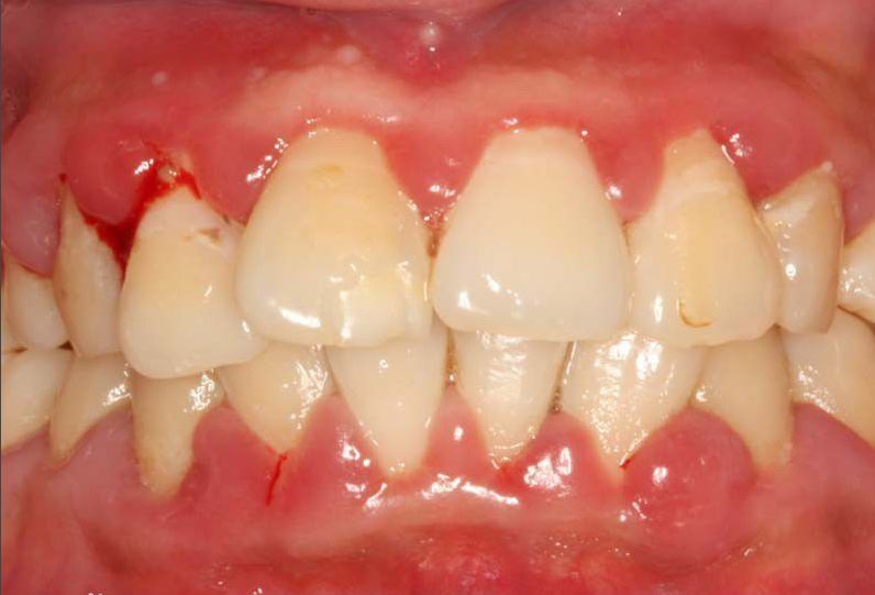 【爱益生】牙龈出血,红肿,胀痛!口腔专家指出千万不要小看牙龈炎.