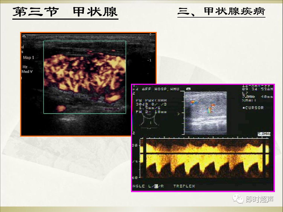 甲状腺超声诊断