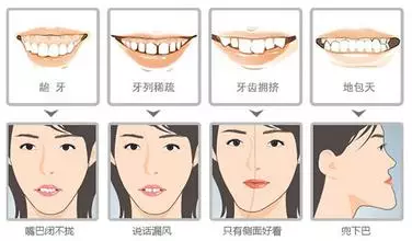 情况二:严重牙齿外暴(俗称暴牙),会引起下腭门牙咬到上颌前牙内侧