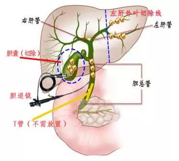 浙江萧山医院普外科采用"双镜"技术解决复杂肝胆管结石