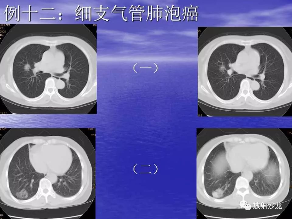 【每日一例| 525例】细支气管肺泡癌