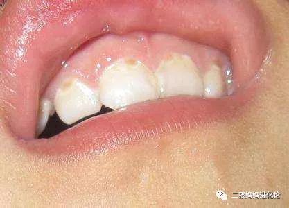 持续关注孩子口腔卫生情况,观察乳牙是否有龋坏的发生及龋坏的进展