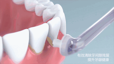 牙医揭秘 | 认真刷牙还蛀牙，竟然是因为牙缝没有清洁干净！