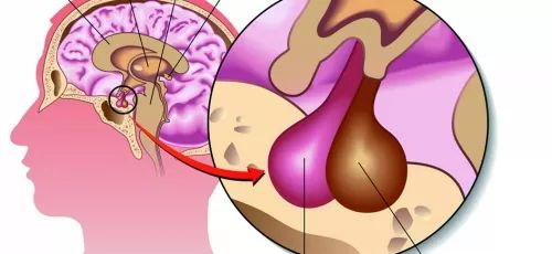 垂体瘤位置示意图