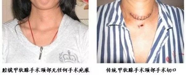 新丰县人民医院成功完成腔镜甲状腺手术!