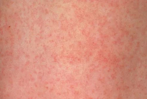 风疹感染的症状包括低热和皮疹,皮疹自面部开始,蔓延到全身,2-3天后可