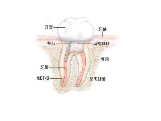 根管治疗术中,专家建议活髓牙或感染仅限于冠髓的患牙可以采用一次法