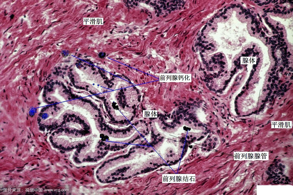 下面再借助前列腺的组织切片,解读一下结石与钙化的区别.
