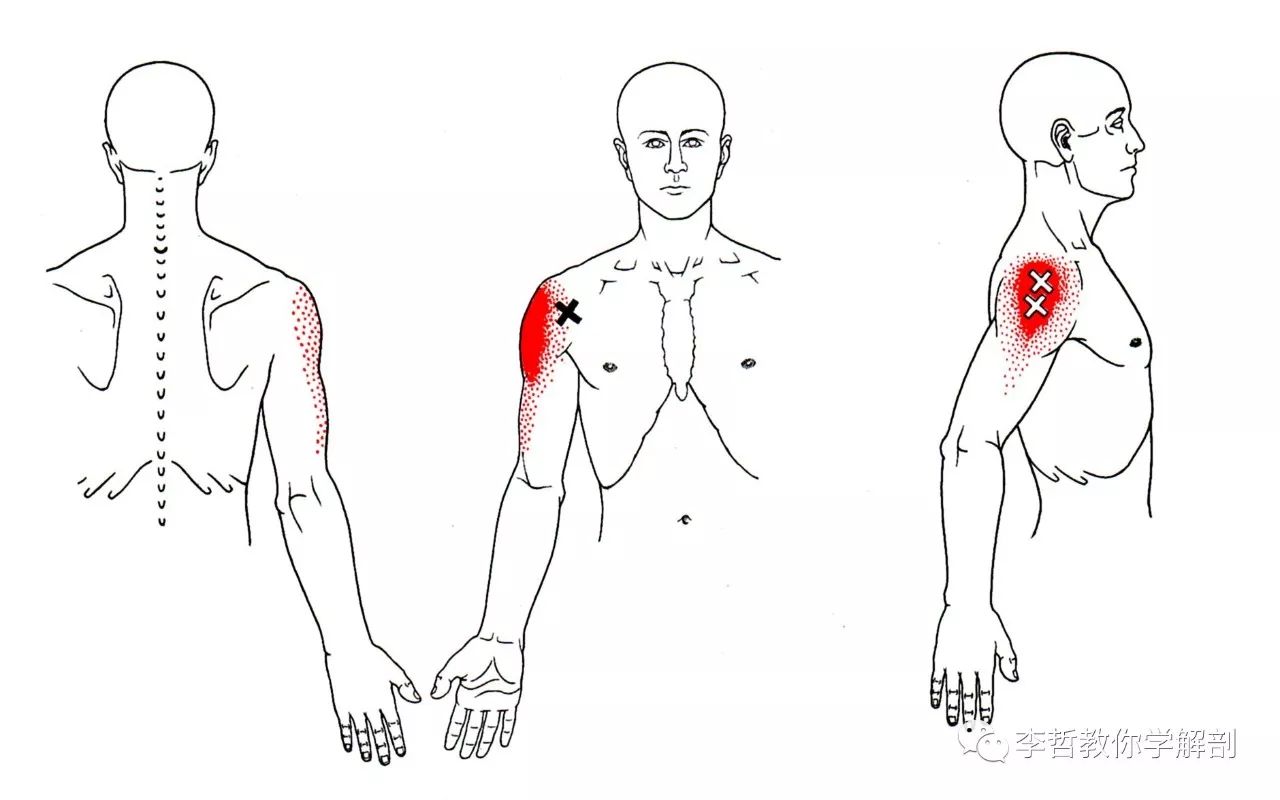 三角肌前部激痛点引发的疼痛,会向肩部前方,侧方进行疼痛传导 三角肌