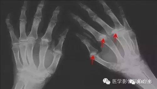 双手x线平片示多个指间关节软组织呈梭形肿胀,双手诸骨骨质疏松,多个