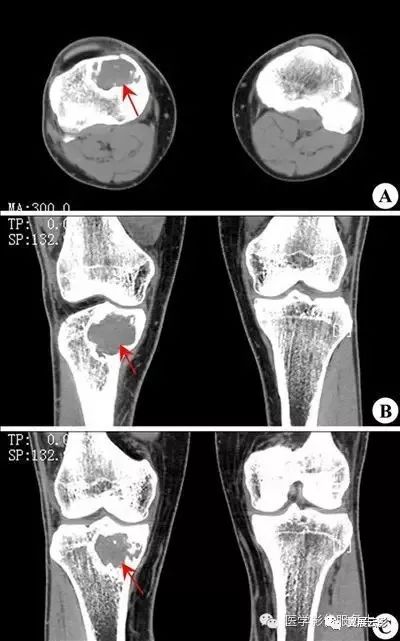 v【ct图片】: 【影像表现】:(a)良性骨巨细胞瘤;(b)骨纤维肉瘤