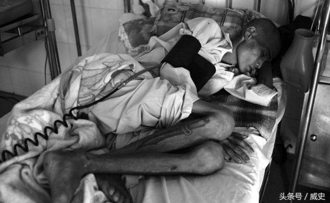 一名艾滋病患者躺在医院的病床上,看起来毫无生气