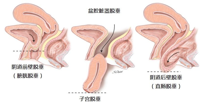 关爱女性,关注盆底健康