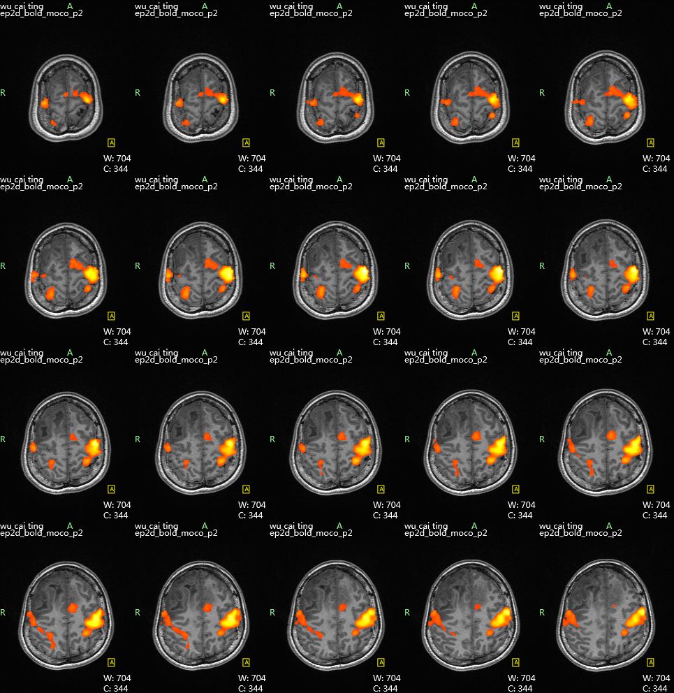 9,磁共振功能成像让脑部肿瘤手术更精准