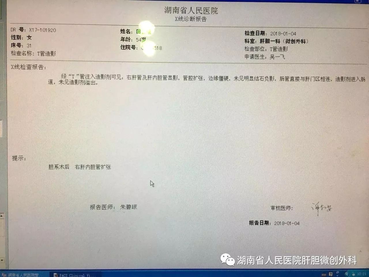 2,多次胆道术后,左肝