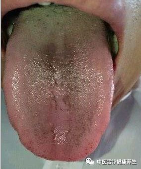 【中医舌诊健康养生】舌头提示你生病的11种症状
