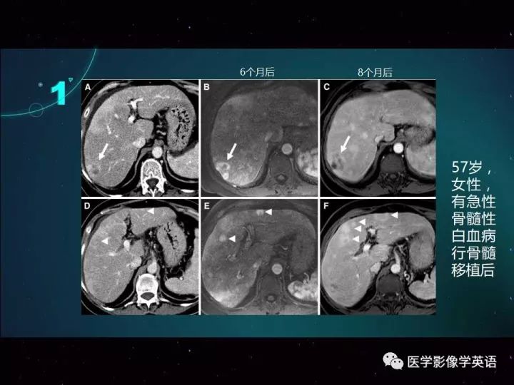 《血管源性的肝脏肿瘤影像学表现》