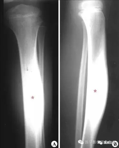 【影像诊断】:左胫骨中段慢性硬化性骨髓炎.