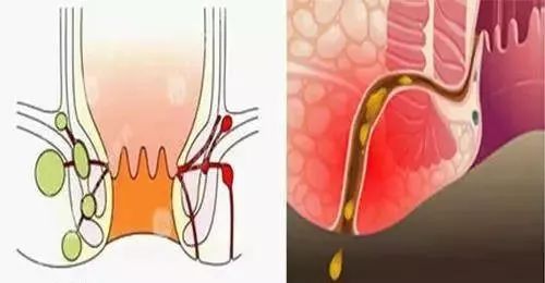 什么是肛瘘