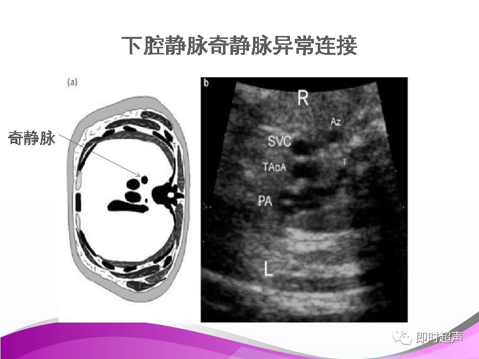 胎儿永存左上腔静脉的超声诊断