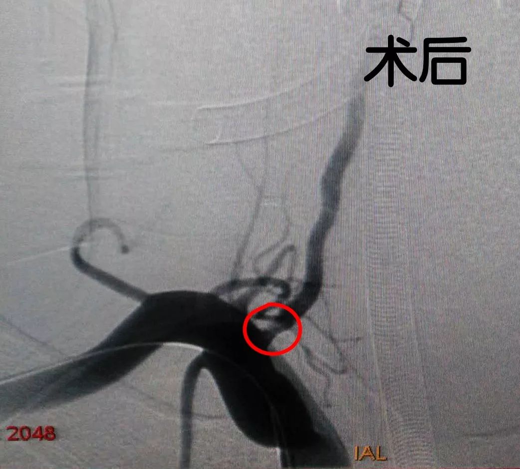 揭秘脑血管中如何放支架