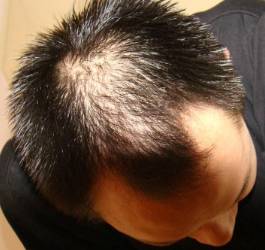 如果头发油,前额和头顶变得稀疏,那就符合遗传性脱发的特征.