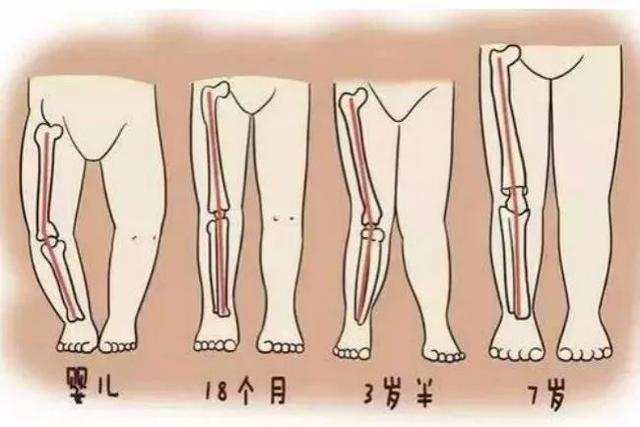 膝内翻/膝外翻明显比同龄的宝宝严重,或左右侧不对称(某一侧比对侧