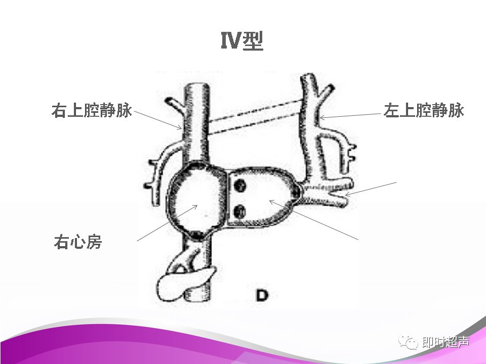 胎儿永存左上腔静脉的超声诊断