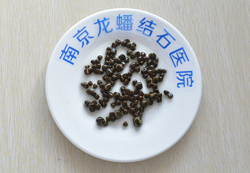 10年病史,140枚黄褐色结石,龙蟠用1cm,2cm两小孔为易