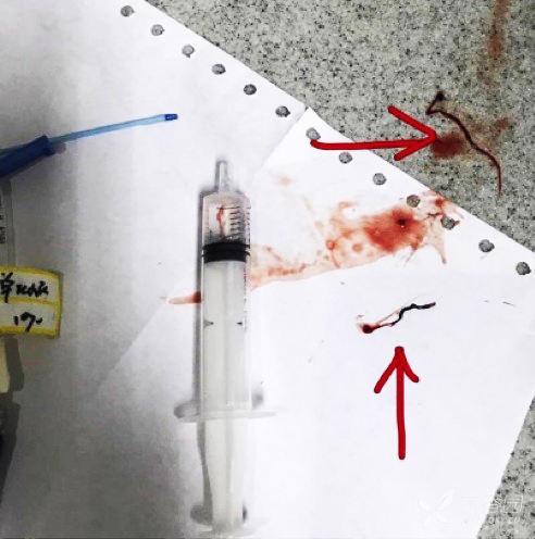 护士必读|留置针回血时,是回抽还是推进?我来告诉你答案!