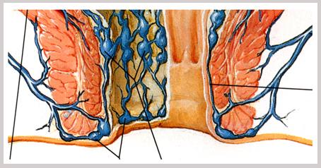 脱肛和痔疮的区别,注意区分!