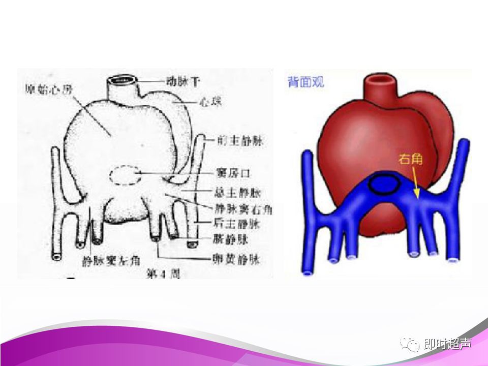 胎儿永存左上腔静脉的超声诊断