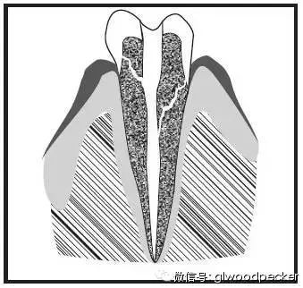因素6:牙根有裂缝