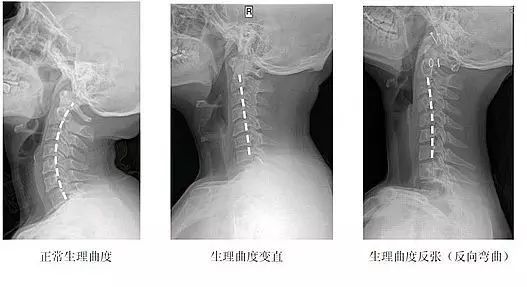 【医学知识】 X线拍片提示颈椎生理曲度变直