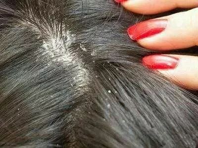 头皮屑 :头皮搔痒,头发上及肩上常发现有白色屑屑,用手拨头发更明显.