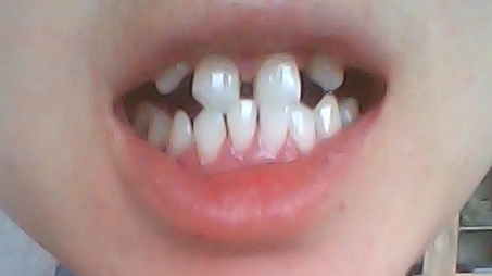 小孩子牙齿稀疏是正常现象吗?