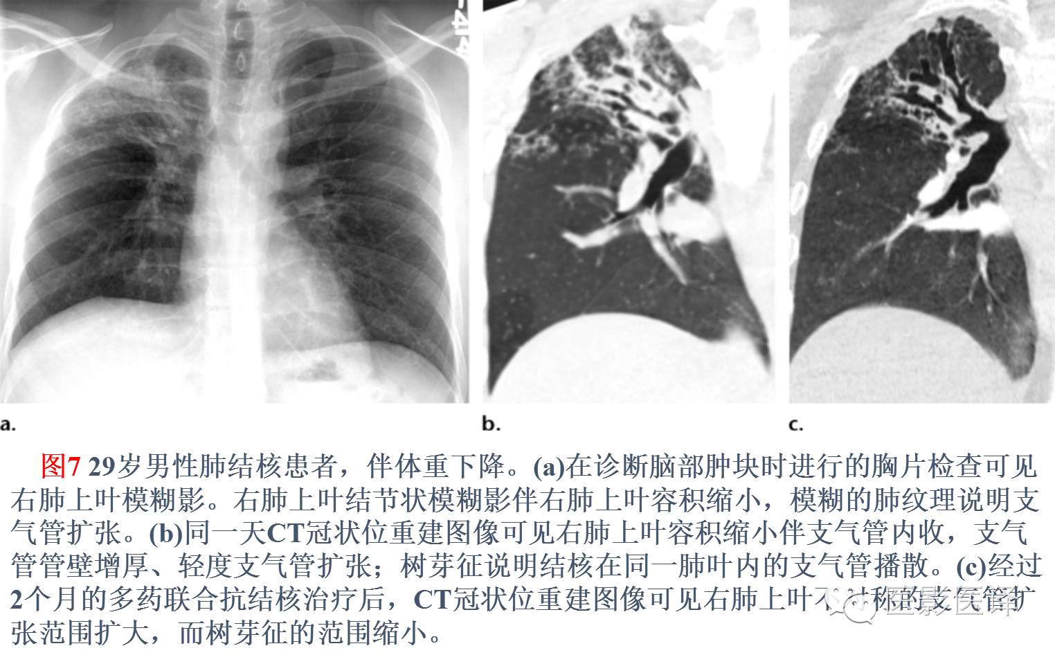 E诊断：肺气肿的影像表现及图像-搜狐