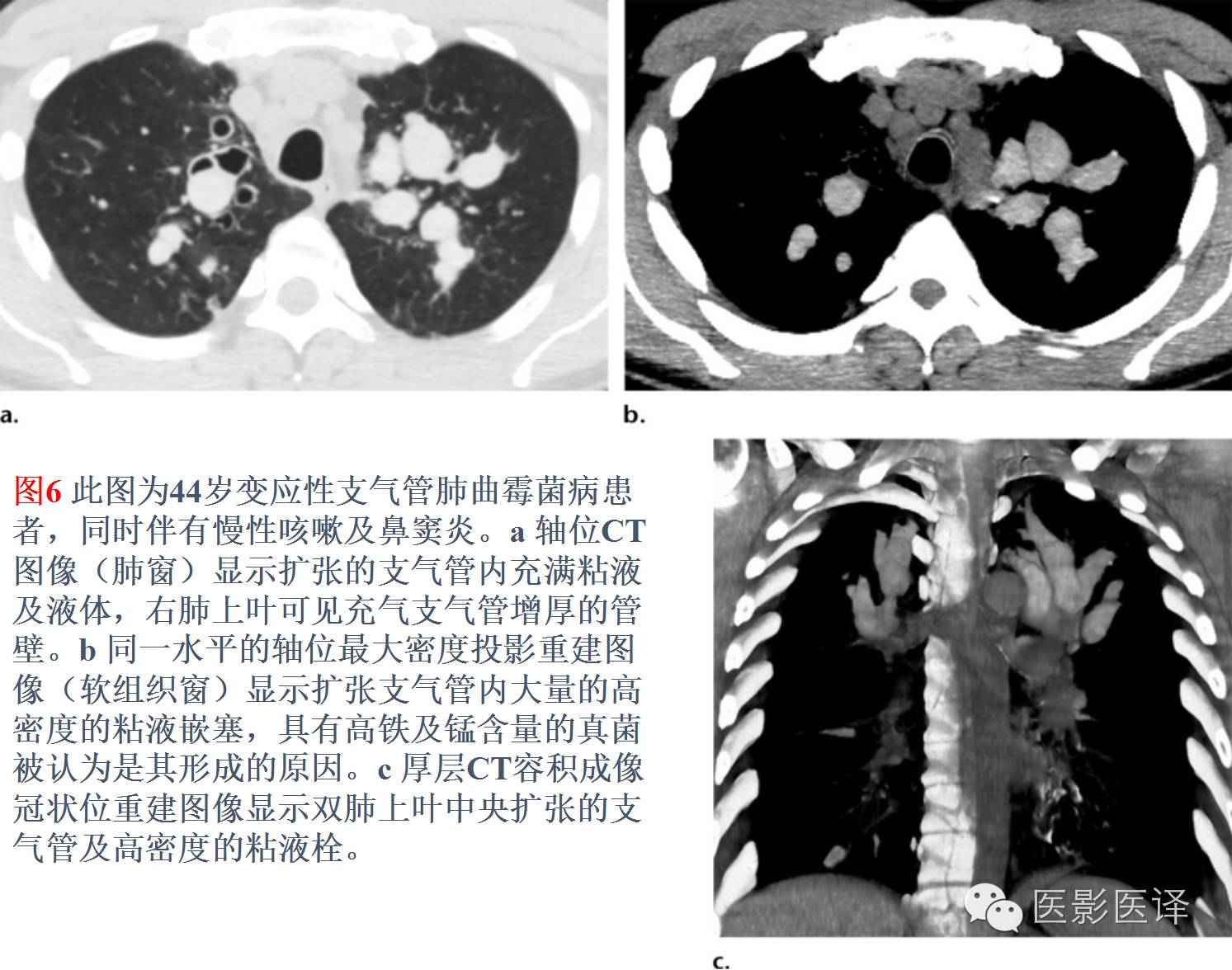 支气管扩张可发生在原发性肺结核之后,往往伴有其他征象,如肺门淋巴结