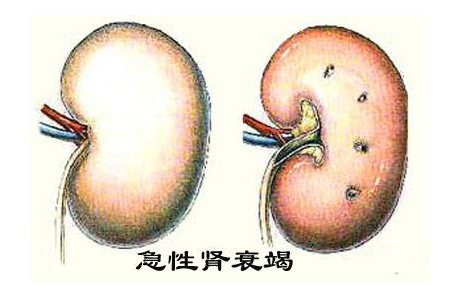 什么是急性肾衰竭?