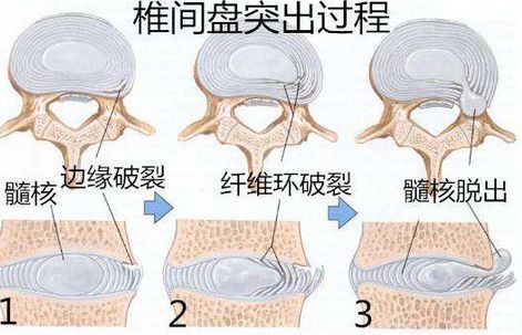 髓核脱水表现,纤维环撕裂表现和软骨终板形成裂隙表现,进一步发展为