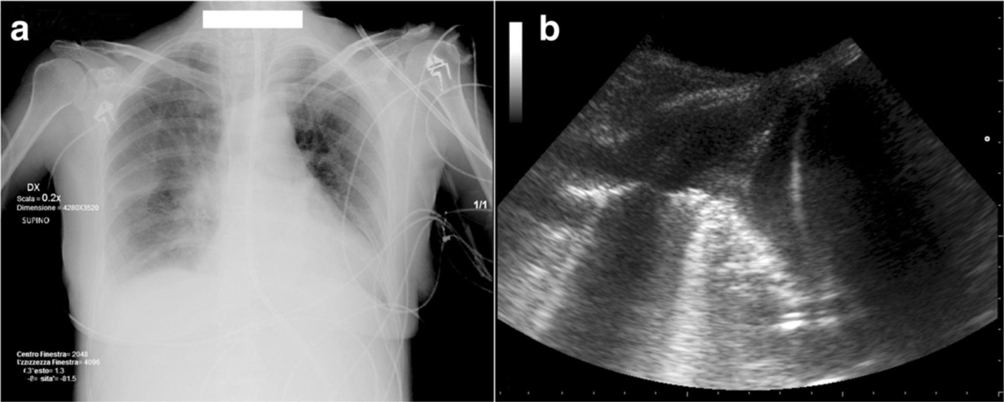 ICU中经胸超声在胸腔积液中的应用（2）----从诊断到治疗 综述